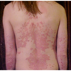 Complexe macérat de bourgeons BIO : Psoriasis - DROMESSENCE