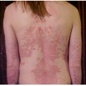 Complexe macérat de bourgeons BIO : Psoriasis - DROMESSENCE